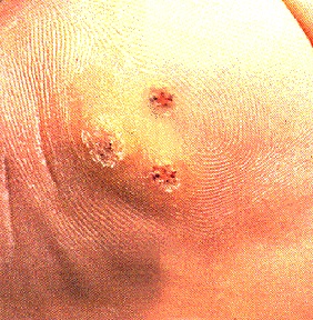 Thentix for warts